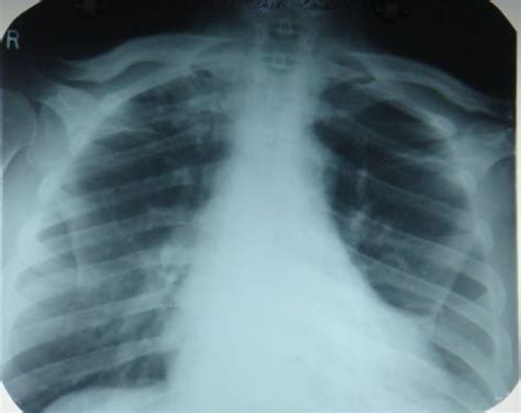 apical lordotic view.